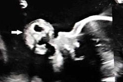 2020 11 18 19 45 4297 2020 11 19 Fetal Teratoma1 20201118190819