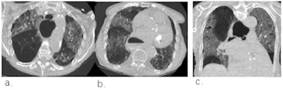 Example chest CT scans of a patient with a true-positive CO-RADS 4 score. (a,b) Two axial slices and (c) a coronal slice of a 79-year-old female with nine days of symptoms. CT shows diffuse ground-glass opacities close to visceral pleural surfaces but superimposed on emphysematous changes. Also note the widened esophagus. COVID-19 was RT-PCR confirmed. Images courtesy of the RSNA.