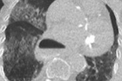 2020 11 18 22 42 5170 2020 11 19 Chest Ct Covid Dutch Image 20201118224158