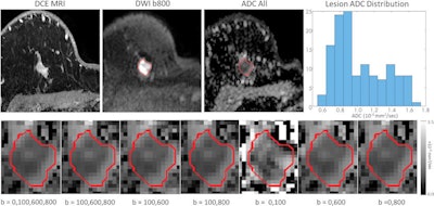 Malignant breast lesion in a 41-year-old woman who underwent axial dynamic contrast material-enhanced (DCE) MRI. Top row, left to right: (1) T1-weighted postcontrast image, (2) DWI image with 800 sec/mm2 b-value, (3) ADC map with all four b-values, (4) ADC histogram for lesion region of interest. Bottom row: ADC maps generated for various b value combinations. Image courtesy of RSNA.