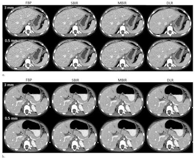 Axial contrast-enhanced CT images from (a) a 13-year-old, 58.3-kg male patient and (b) a 4-year-old, 13-kg male patient were reconstructed at 3-mm and 0.5-mm image thicknesses with filtered back projection (FBP), statistical-based iterative reconstruction (SBIR), model-based iterative reconstruction (MBIR), and deep-learning reconstruction (DLR). Images and caption courtesy of Radiology.