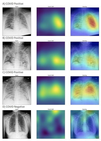 DeepCOVID-XR's generated heat maps correctly highlighted abnormalities in the lung fields in those images accurately labeled as COVID-19 positive (A-C) in contrast to images that were accurately labeled as negative for COVID-19 (D). Intensity of colors on the heat map corresponds to features of the image that are important for prediction of COVID-19 positivity. Image and caption courtesy of Northwestern University.