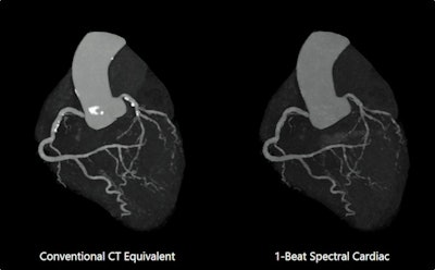 Image shows one-beat cardiac CT scan in deep-learning spectral mode. Spectral results demonstrate improved lumen visualization in presence of calcification. Spectral Cardiac pending 510(k) clearance on Aquilion One / Prism Edition scanner. All Images courtesy of Canon.