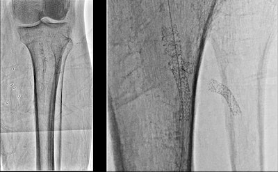 Image of a stent in popliteal and anterior tibial arteries: standard resolution with 12-inch field-of-view (left) and Hi-Def resolution with 3-inch field-of-view (right).