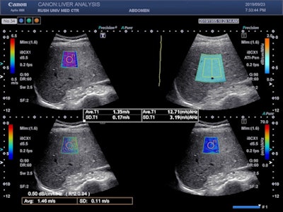 Image shows the Aplio i-series liver analysis technologies (shear-wave elastography, attenuation imaging, and shear-wave dispersion) and propagation map acquired simultaneously in real-time.