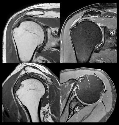 MR images of the shoulder acquired at 3-tesla and reconstructed with AiCE show submillimeter resolution for detailed orthopedic imaging.
