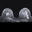 2019 07 22 20 17 2160 Mri Breast 400