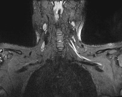 An MR image of a patient in their early 20s shows nerve injury of the left brachial plexus in the neck. The patient experienced left arm weakness and pain after recovering from COVID-19 respiratory illness, which prompted them to see their primary care physician. As a result of the MRI findings, the patient was referred to the COVID-19 neurology clinic for treatment. Image and caption courtesy of Northwestern University.