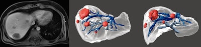 Liver metastasis of colorectal carcinoma. Five liver metastases were identified on MRI with hepatospecific agent. The 3D model was useful for surgical planning due to the well established relationships between the metastasis and the vessels as well as the 3D positioning of the nodules within the liver.