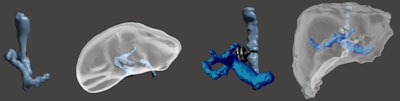 Left images: 3D model for interventional planning in a 5-year-old boy with a congenital intrahepatic portosystemic shunt. Right images: 3D model after shunt closure with Amplatzer device (silver color) in a 4-year-old boy with a congenital portosystemic shunt.