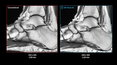 Ankle images with conventional MR reconstruction (left) and GE's AIR Recon DL reconstruction (right).