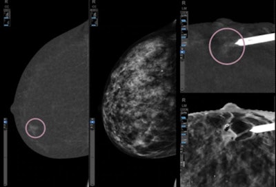 GE's Serena Bright software can assist in breast interventions, as in the case of this clip deployment.