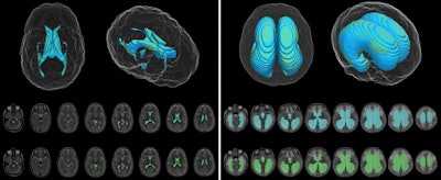 Deep-learning model (blue) and ground-truth manual (green) segmentation of representative control (left) and hydrocephalus (right) T2-weighted MR images. Image courtesy of the American Association of Neurological Surgeons.