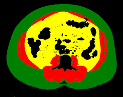 Example of body composition analysis of an abdominal CT slice with subcutaneous fat in green, skeletal muscle in red, and visceral fat in yellow. Image and caption courtesy of Dr. Kirti Magudia, PhD, and the RSNA.