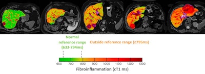 Hepatica helps surgeons to identify and characterize previously undiagnosed background liver disease. Image courtesy of Perspectum.
