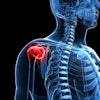 2020 12 04 00 58 8340 Shoulder Injury X Ray 400