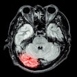 2020 12 04 23 36 7251 Ct Brain Stroke1 400