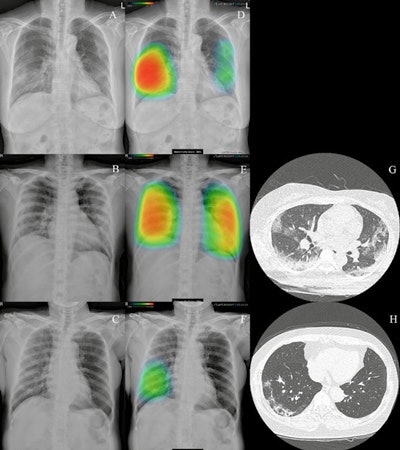 Lunit Insight CXR identifies COVID-19 pneumonia from chest radiographs. Image courtesy of Lunit.