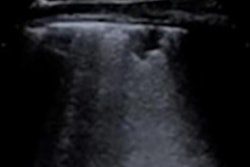 2020 12 11 01 09 7440 2020 12 11 Lung Ultrasound Scan 20201211012429