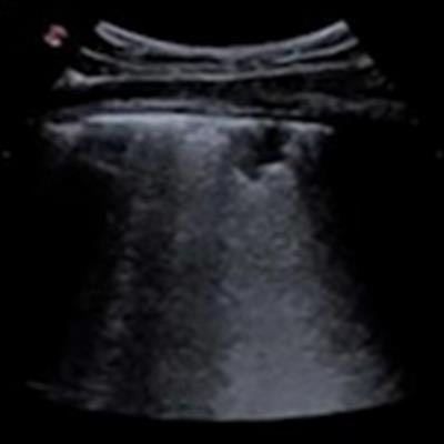 2020 12 11 01 09 7440 2020 12 11 Lung Ultrasound Scan 20201211012429