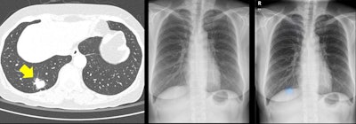 Left: Image of a 64-year-old woman with confirmed lung adenocarcinoma at the right lower lobe (arrow). Center: The lesion, located at the right retrodiaphragmatic area, was missed during routine clinical practice. Right: In the reader performance test, none of the thoracic radiologists detected the lesion. The algorithm successfully localized the lesion (light blue shaded area) with a probability score of 0.16. Caption and images courtesy of the RSNA.
