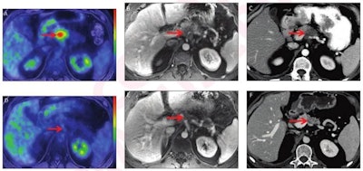 52-year-old man with locally advanced pancreatic adenocarcinoma and major pathologic response. Pretreatment (A-C) and post-treatment (D-F) images after eight cycles of systemic Folfirinox and consolidative chemoradiation. Baseline CA 19-9 was 145 U/ml. Pretreatment whole-body axial fused PET/MRI showed FDG-avid lesion in body of pancreas (arrow, A) with SUVmax 7.1 and SUVgluc 8.0. Lesion was hypoenhancing on axial contrast-enhanced T1-weighted MR image (arrow, B) from focused abdominal PET/MRI and on CT (arrow, C). Pretreatment CT tumor volume was 10.3 cm3. Post-treatment whole-body axial fused PET/MRI showed complete metabolic response (arrow D) with SUVmax 1.9 and SUVgluc 1.9. Lesion was indistinct on axial contrast-enhanced T1-weighted MRI (arrow, E) and CT (arrow, F), and there was upstream pancreatic parenchymal atrophy. Post-treatment CT tumor volume was 0.46 cm3. There was normalization of CA 19-9. Relative change in SUVmax was -73%, and relative change in SUVgluc was -76%. Based on change in tumor size, response was categorized as partial response per RECIST. Relative change in tumor volume was -96%. Pathology showed major pathologic response (College of American Pathologists score 1). Images and caption courtesy of the American Roentgen Ray Society and the American Journal of Roentgenology.