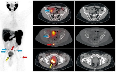 Ga-68 PSMA-11 PET/CT images of a patient with prostate cancer. Conventional imaging was negative for extraprostatic disease spread (metastasis). The PSMA PET/CT image shows prostate cancer lesions. The image enables clinicians to stage the disease as metastatic, therefore enabling the patient to avoid undergoing local therapy alone, which would fail. Yellow arrow shows the primary prostate tumor, blue arrows show the pelvic lymph nodes metastasis, and red arrows show bone metastasis. Images courtesy of Dr. Jeremie Calais and UCLA.