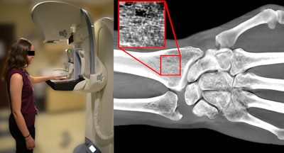 Left, a 19-year-old woman undergoing a wrist imaging using a DBT scanner. Right, DWT image of same patient. Image courtesy of Yener Yeni, PhD.