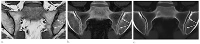 Images in a 51-year-old woman with erosions