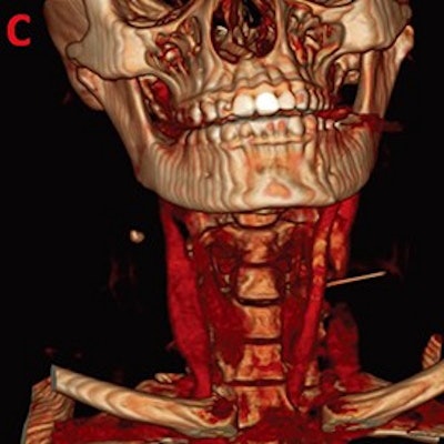 3D rendering of swallowed needle