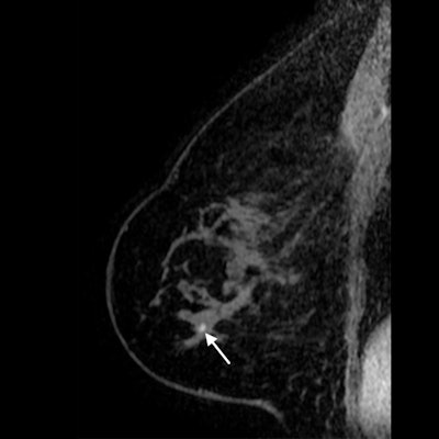 Sagittal T1-weighted fat-saturated contrast-enhanced MRI image of 71-year-old woman with history of breast cancer who presented for screening MRI. Arrow points to 4-mm focus in right breast at middle depth. MRI-guided core needle biopsy showed grade 1 invasive lobular carcinoma. All images courtesy of RSNA.