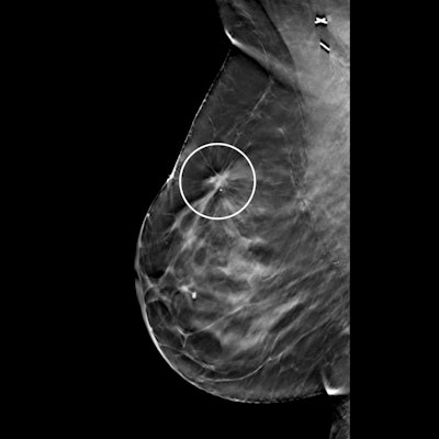 Screening mammography image of same patient taken six months prior. Right mediolateral oblique tomosynthesis image was interpreted as benign, with the circle highlighting postsurgical changes. The cancer diagnosed after MRI screening was confirmed to be an interval cancer.