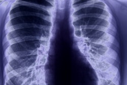 2019 03 27 20 35 9511 X Ray Chest Lungs2 400