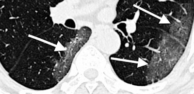 CT scan of lungs of COVID-19 patient with areas described by radiologists as resembling grains of ground glass. Image courtesy of RSNA.