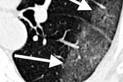 2020 08 05 20 43 6745 2020 08 05 Nih Covid Lungs 20200805201551