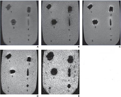 MRI of nonferromagnetic ballistics suspended in gelatin. Scout (A), T1-weighted spin-echo; (B), T2-weighted SE (C); T2-weighted gradient-recalled echo; (D), and T2-weighted gradient-recalled echo; (E) MR images show jacket hollow point .45 automatic Colt pistol bullet (1), solid lead .45 Long Colt bullet (2), full metal jacket automatic Colt pistol bullet (3), 5.56-mm full metal jacket bullet (4), #7 lead shotgun pellet (5), and 5-mm lead air gun pellet (6). On all sequences, metallic artifact is minimal. Images and caption courtesy of the American Roentgen Ray Society (ARRS).
