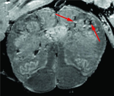 High-resolution MRI scan of a patient's brain stem. Arrows point to light and dark spots that are indicative of blood vessel damage observed in the study. Image courtesy of the NIH.