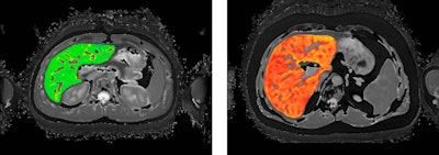 LiverMultiScan example images of low cT1 and high cT1. Images courtesy of Perspectum.