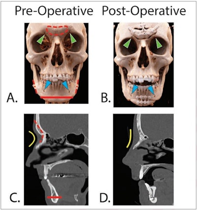 Pre- and postoperative CT scans in two different patients undergoing facial feminization surgery. Frontal 3D reformatted images (A) before and (B) after surgery in a 29-year-old transgender woman. Red dashed line indicates frontal bone osteotomy. Red dash-dot lines indicate mandibular angle osteotomies. Red solid line indicates genioplasty. Green arrowheads indicate superior orbital foraminal notches. Blue arrowheads indicate mental foramina. Sagittal reformatted images (C) before and (D) after surgery of 39-year-old transgender woman. Note the Osterhout type 1 frontal sinus. Red dashed line indicates frontal bone recontouring. Red solid line indicates genioplasty. The nasofrontal angle (yellow line) is increased postoperatively. Images and caption courtesy of the American Roentgen Ray Society (ARRS).