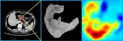 CT image (left) of gastric cancer patient with peritoneal metastasis, along with output of deep-learning model (center and right). Images courtesy of the Shenzhen Institutes of Advanced Technology.