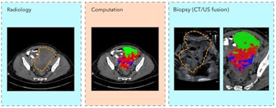 Individual and combined ovarian biopsy scans. Image courtesy of Evis Sala of the University of Cambridge.