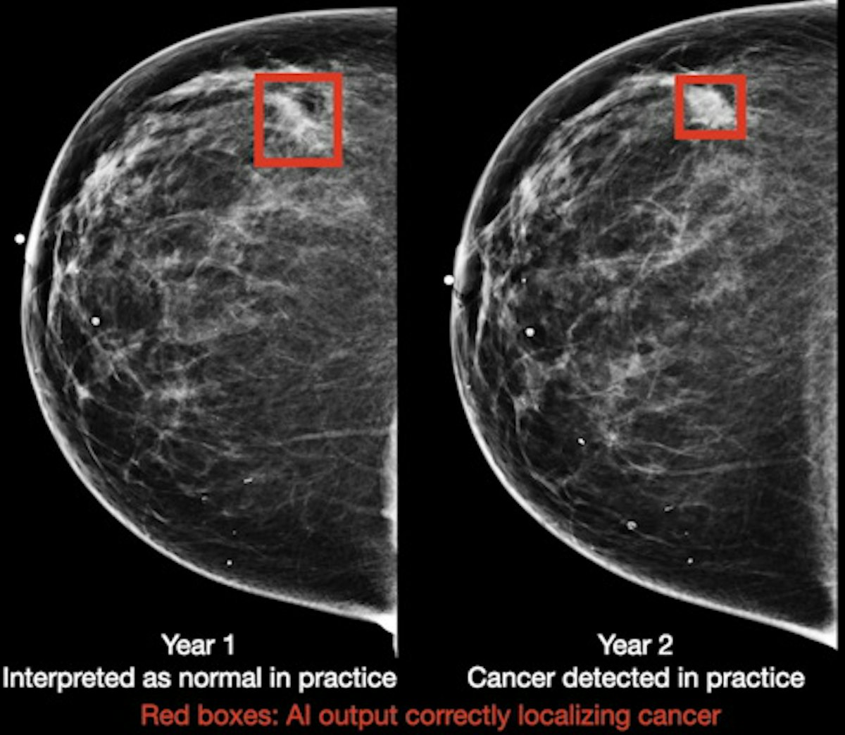 Breast Cancer  Mammogram 