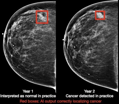 Breast cancer case detected by AI algorithm on mammogram one year before it was diagnosed by a radiologist. Image courtesy of DeepHealth.