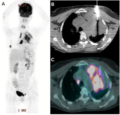 Images are from a patient with lung mass who was referred for FDG-PET/CT. The PET image (A) shows multiple lesions in the left lung, lymph nodes, and bones. The axial CT thoracic image (B) shows the placement of the coaxial guide needle in the lesion that does not differentiate atelectasis from the metabolic active lung lesion. The axial PET/CT fused image (C) confirms the positioning of the coaxial guide needle in the metabolic border of the lesion, which ensures that metabolically active specimens will be collected with a needle that can be inserted 2 cm further. A pathological analysis confirmed adenocarcinoma. Images courtesy of the Journal of Nuclear Medicine.