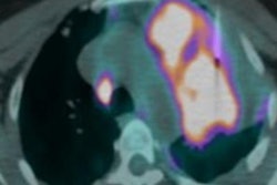 2021 01 11 17 44 3678 2020 01 15 Fdg Pet Ct Guided Lung Biopsies 20210111174926
