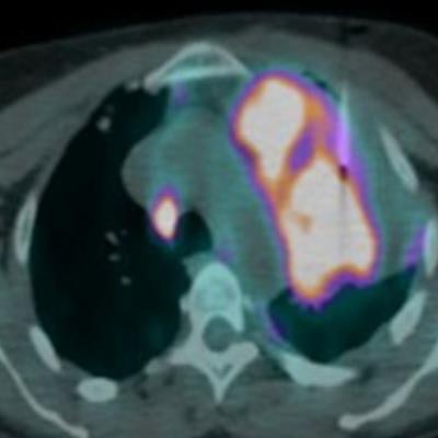 2021 01 11 17 44 3678 2020 01 15 Fdg Pet Ct Guided Lung Biopsies 20210111174926