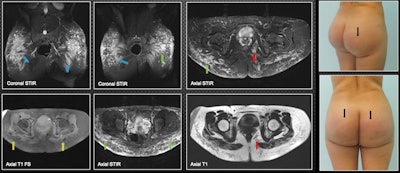 A 28-year-old patient was injected with biopolymers in the gluteal region seven years ago and now is experiencing inflammatory skin changes (blue arrows). MRI shows biopolymers located mainly in the subcutaneous cell tissue of the gluteal region, predominantly in the upper external quadrant in the form of vacuoles (green arrows). There is compromise of the gluteus maximus, where biopolymers are seen adopting a fusiform pattern at this level (blue arrows). There is migration to the left ischioanal fossa (red arrows). The yellow arrows show its hypointense behavior in T1-weighted fat-saturation sequences; the material has a hyperintense behavior in the short-tau inversion recovery sequences.