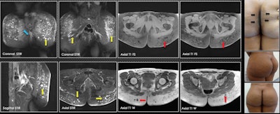 A 35-year-old patient was injected with biopolymers in the gluteal region five years ago. Three years later, changes in the coloration of the skin are visible between the gluteal folds (blue arrow). On MRI, there are multiple vacuoles of hyperintense behavior in the short-tau inversion recovery sequences (yellow arrows) and vacuoles of hypointense behavior in the sequences with T1-weighted information (red arrows), which are compatible with biopolymers located mainly in subcutaneous tissue. In the gluteus maximus muscle, biopolymers are seen in the fusion form (blue arrow). No vacuoles were identified at this level.