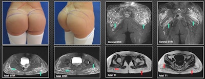 A 29-year-old patient was injected with biopolymers in the gluteal region six years ago to increase volume. She is currently asymptomatic, but she decided to schedule surgical removal of the material. MRI shows multiple nodular and other elongated lesions in the subcutaneous cellular tissue of the gluteal region. They are hypointense on T1-weighted images (red arrows) and hyperintense on T2-weighted and short-tau inversion recovery images (green arrows). This is compatible with biopolymers, which also compromise the maximum gluteal muscles bilaterally, especially on the left side; the other muscle groups in the pelvis show no infiltration by biopolymers. All figures courtesy of Dr. John J. Echeverri and RSNA 2020.