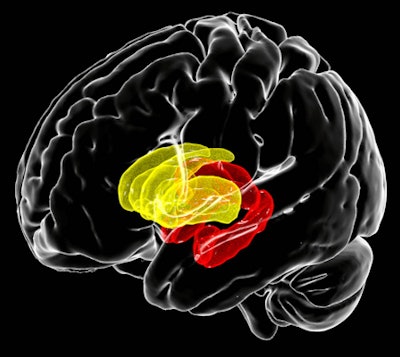 The shift of HIV infection from a fatal to chronic condition in the era of more widely available treatment appears to be accompanied by a shift in the profile of HIV-related brain abnormalities beyond the basal ganglia (yellow), frequently implicated in earlier studies, to limbic structures (red). MR image courtesy of Talia Nir, PhD; Neda Jahanshad, PhD; and James Stanis of the Mark and Mary Stevens Neuroimaging and Informatics Institute at the Keck School of Medicine of USC.